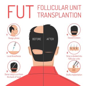 FUT Hair Transplant in Abu Dhabi